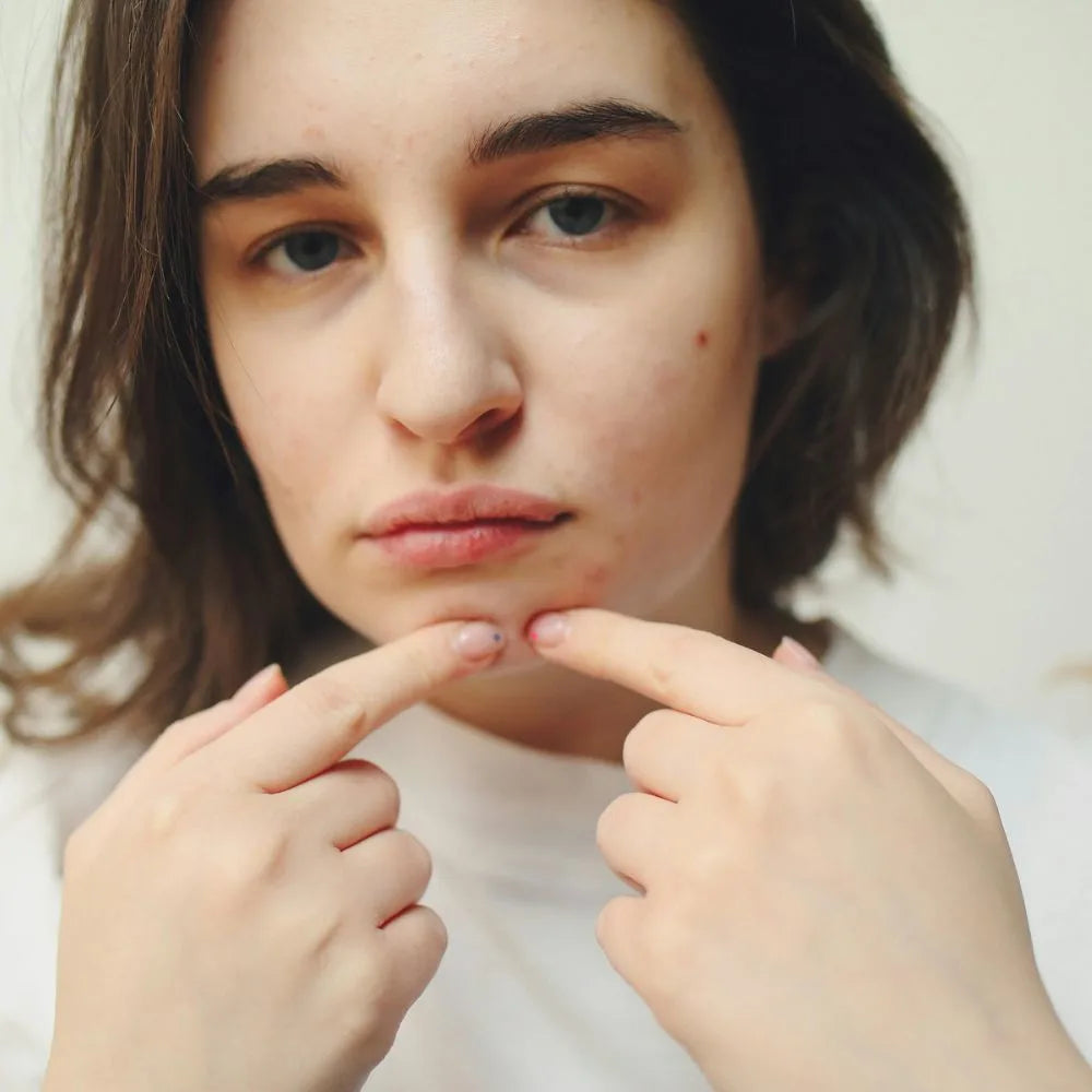 Tackling Acne & Breakouts: The Ola Skincare Guide for Clearer Skin in Pakistan